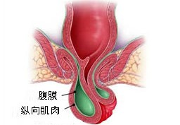 直肠脱垂