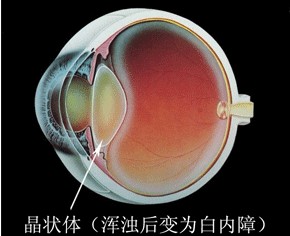 白内障