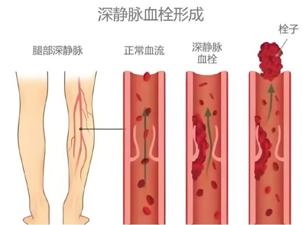 润心科普｜腿疼、肿胀、皮温升高，警惕下肢深静脉血栓！